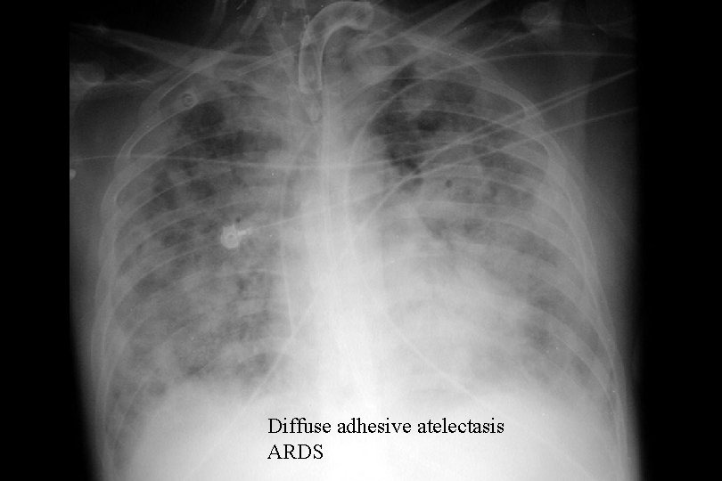 Diffuse adhesive atelectasis ARDS 