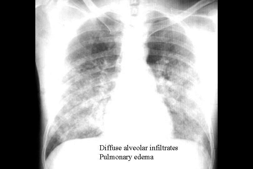 Diffuse alveolar infiltrates Pulmonary edema 