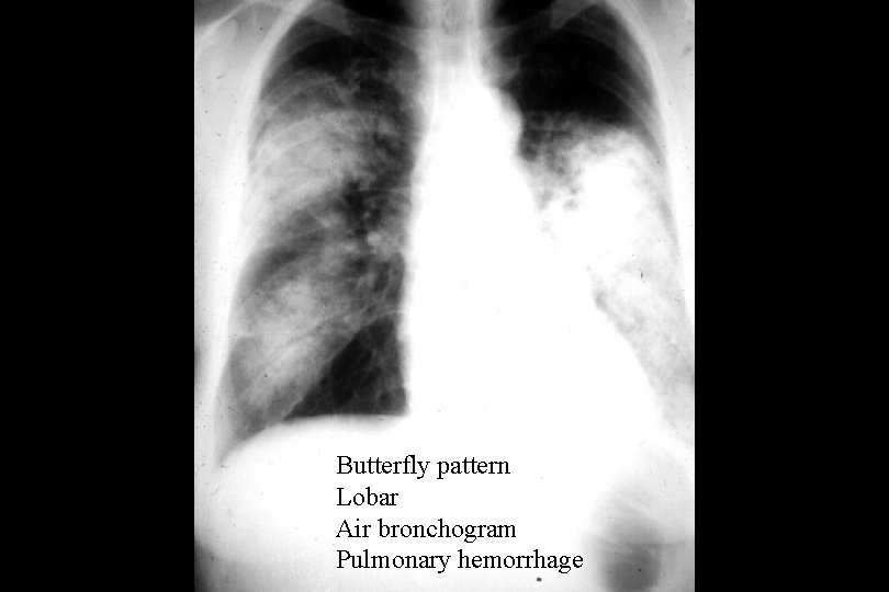 Butterfly pattern Lobar Air bronchogram Pulmonary hemorrhage 