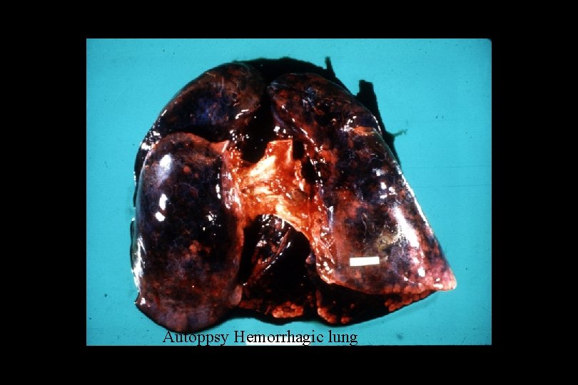 Autoppsy Hemorrhagic lung 