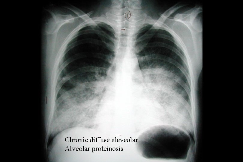 Chronic diffuse aleveolar Alveolar proteinosis 