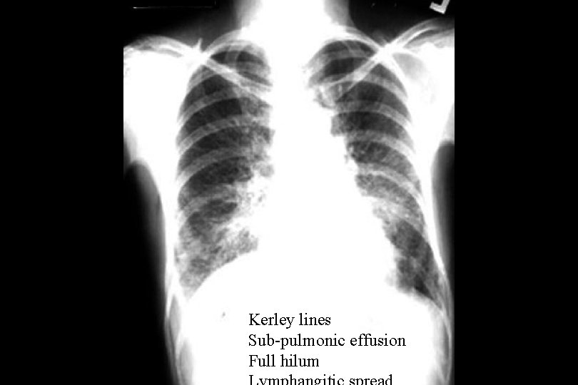 Kerley lines Sub-pulmonic effusion Full hilum 