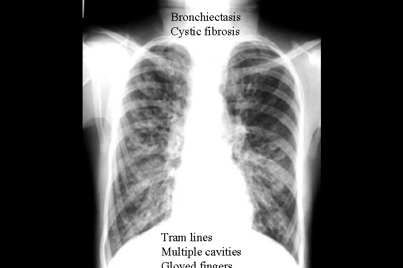 Bronchiectasis Cystic fibrosis Tram lines Multiple cavities 