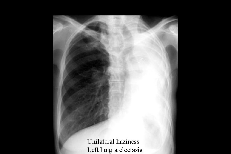 Unilateral haziness Left lung atelectasis 