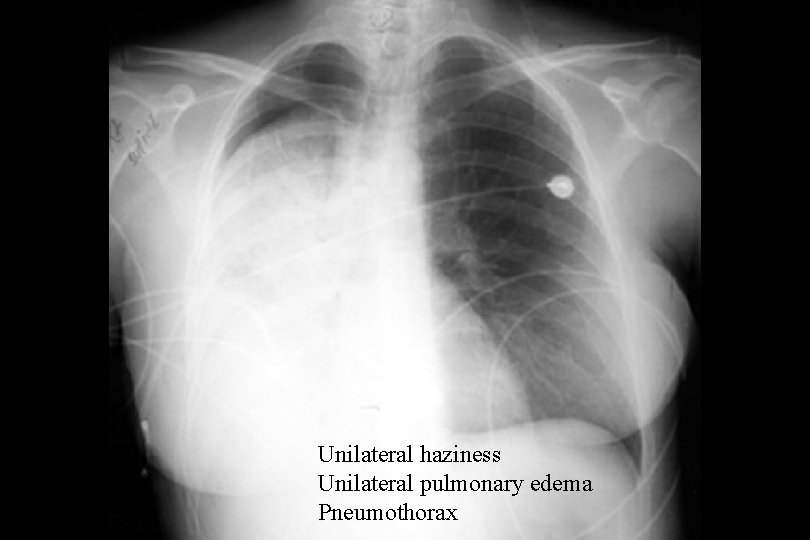 Unilateral haziness Unilateral pulmonary edema Pneumothorax 