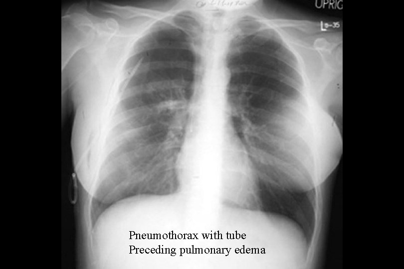 Pneumothorax with tube Preceding pulmonary edema 