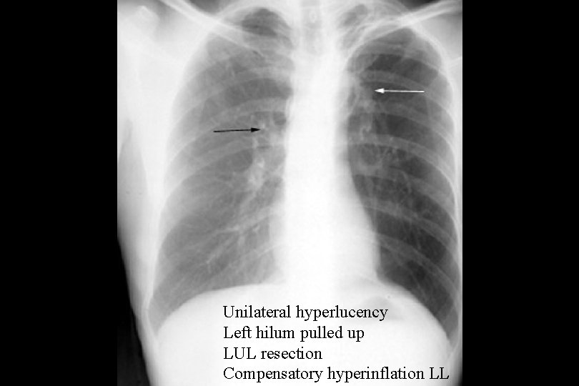 Unilateral hyperlucency Left hilum pulled up LUL resection Compensatory hyperinflation LL 