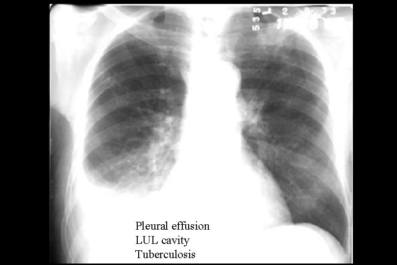 Pleural effusion LUL cavity Tuberculosis 