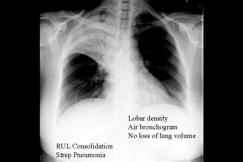 Lobar density Air bronchogram No loss of lung volume RUL Consolidation Strep Pneumonia 