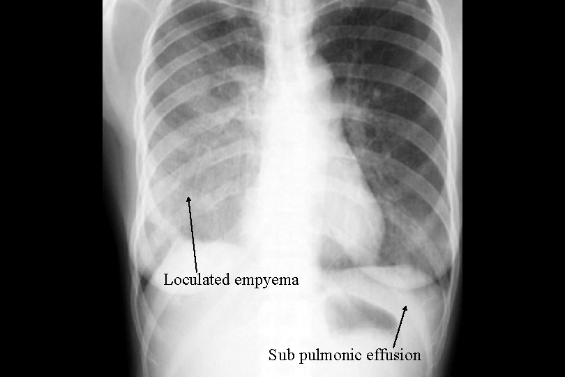 Loculated empyema Sub pulmonic effusion 