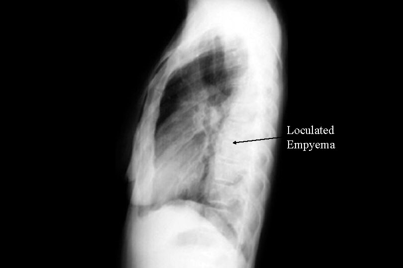 Loculated Empyema 