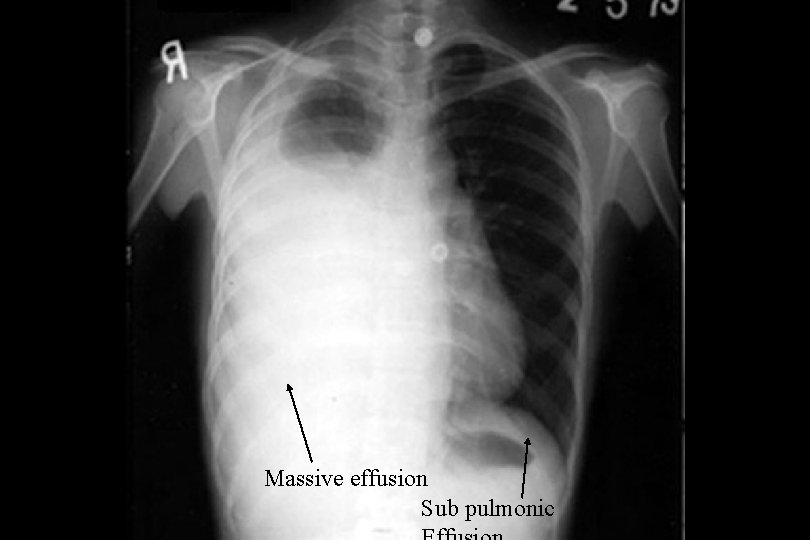 Massive effusion Sub pulmonic 