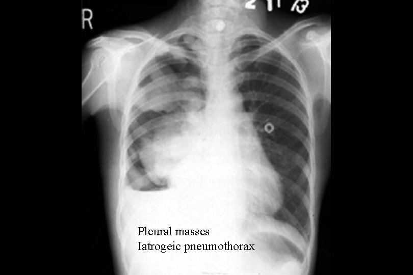 Pleural masses Iatrogeic pneumothorax 