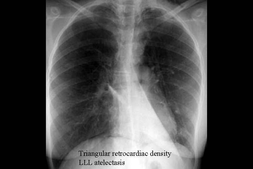 Triangular retrocardiac density LLL atelectasis 