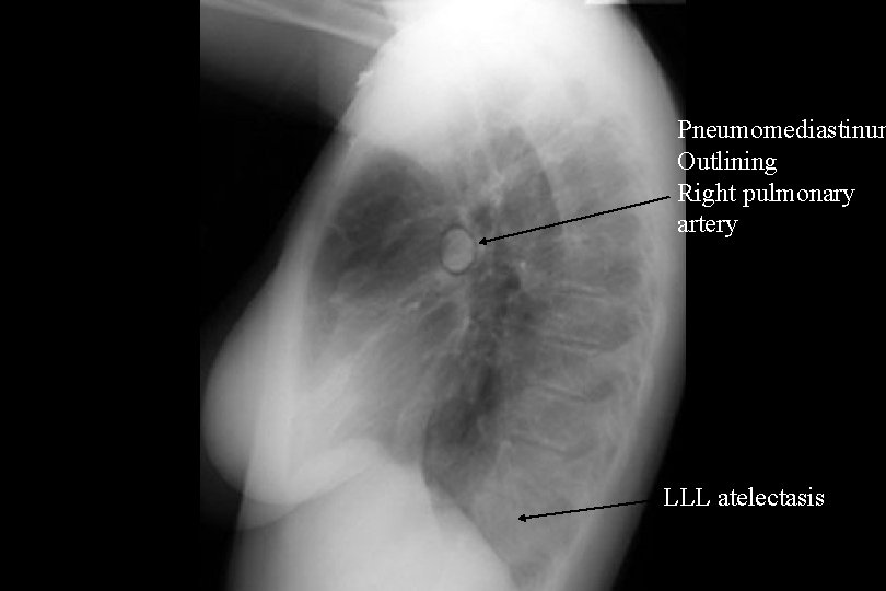 Pneumomediastinum Outlining Right pulmonary artery LLL atelectasis 