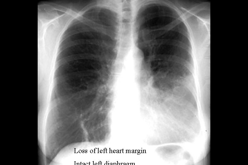 Loss of left heart margin 