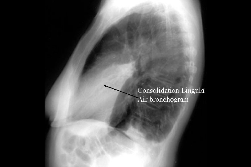 Consolidation Lingula Air bronchogram 