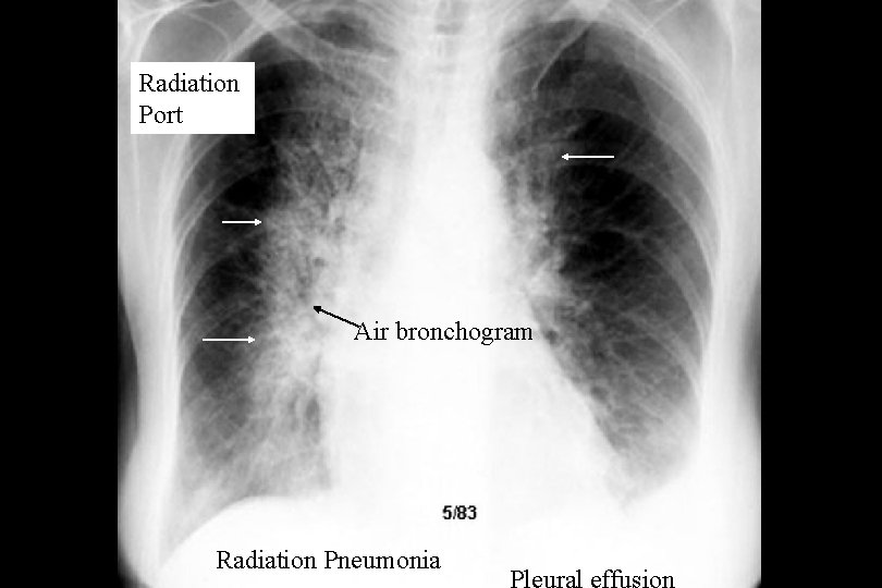 Radiation Port Air bronchogram Radiation Pneumonia 