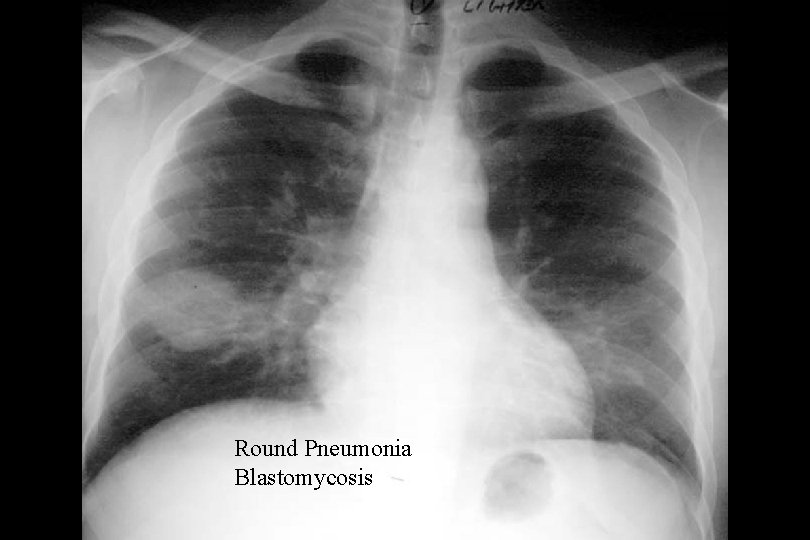 Round Pneumonia Blastomycosis 