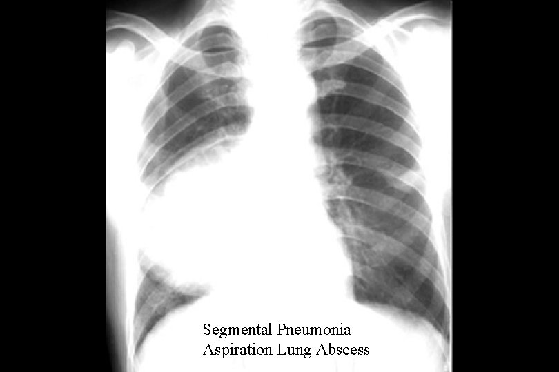 Segmental Pneumonia Aspiration Lung Abscess 