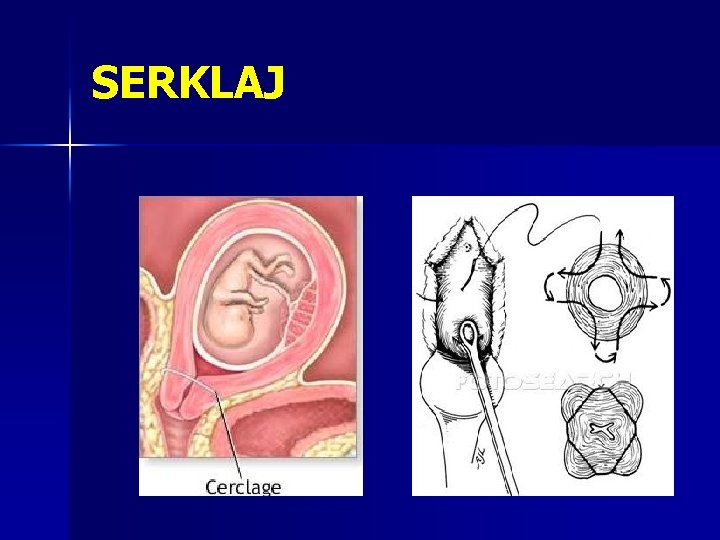 SERKLAJ SERKLAJ