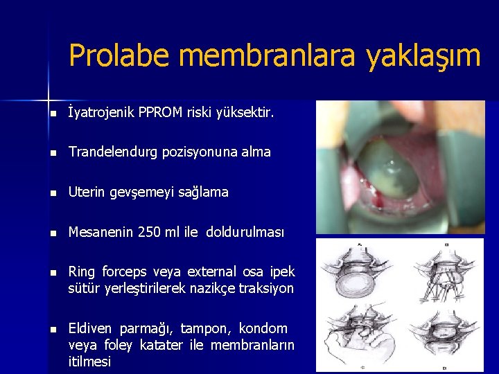 Prolabe membranlara yaklaşım n İyatrojenik PPROM riski yüksektir. n Trandelendurg pozisyonuna alma n Uterin Prolabe membranlara yaklaşım n İyatrojenik PPROM riski yüksektir. n Trandelendurg pozisyonuna alma n Uterin