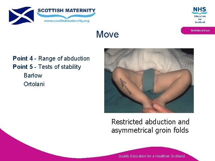 Move Point 4 - Range of abduction Point 5 - Tests of stability Barlow