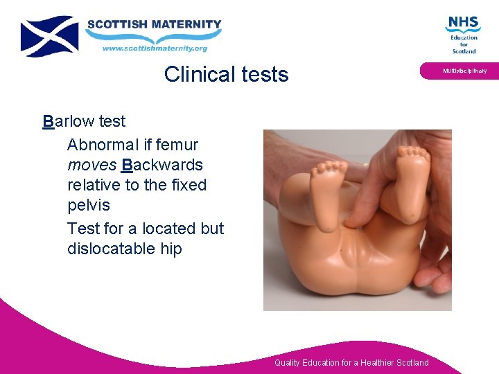 Clinical tests Barlow test Abnormal if femur moves Backwards relative to the fixed pelvis