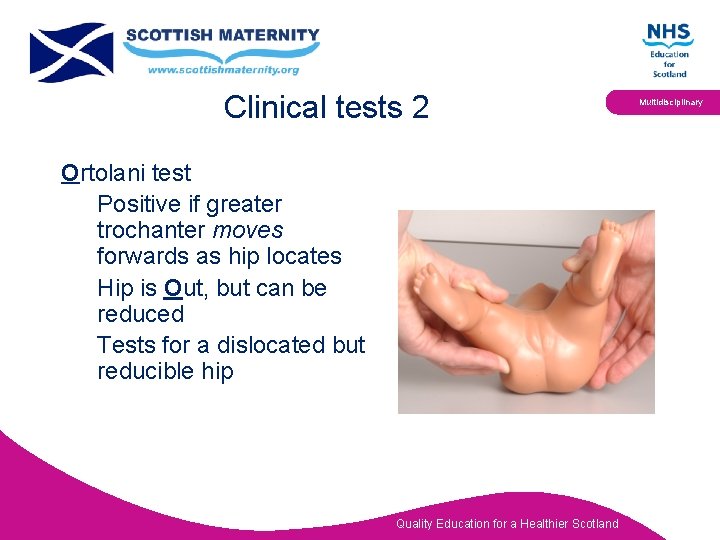 Clinical tests 2 Ortolani test Positive if greater trochanter moves forwards as hip locates