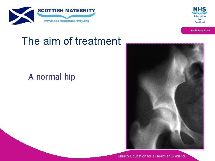 Multidisciplinary The aim of treatment A normal hip Quality Education for a Healthier Scotland