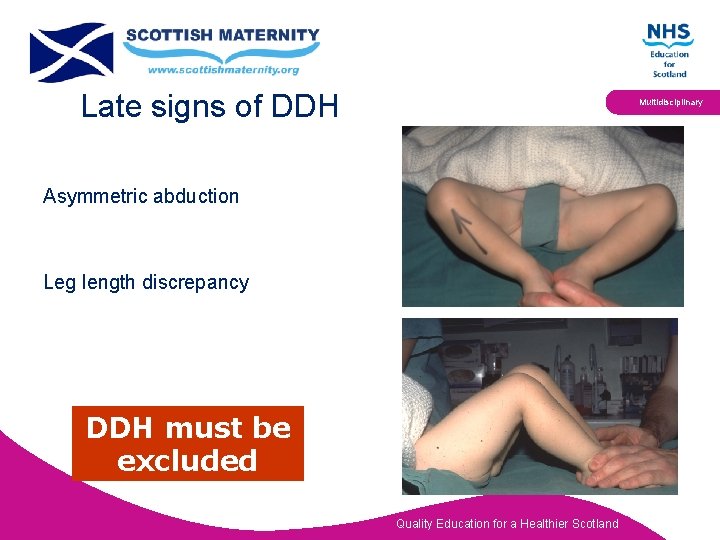 Late signs of DDH Multidisciplinary Asymmetric abduction Leg length discrepancy DDH must be excluded