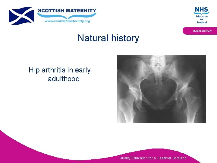 Multidisciplinary Natural history Hip arthritis in early adulthood Quality Education for a Healthier Scotland