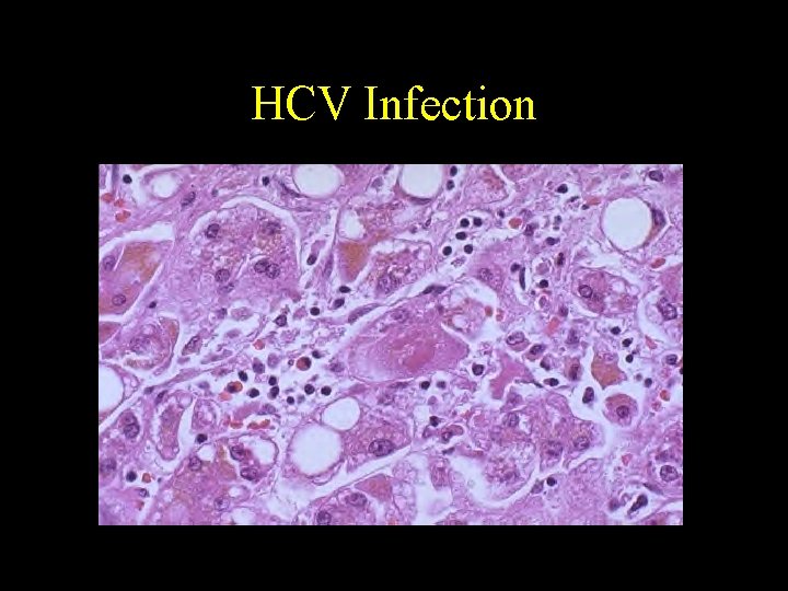 HCV Infection 