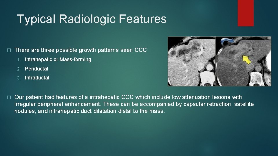 Typical Radiologic Features � � There are three possible growth patterns seen CCC 1. Typical Radiologic Features � � There are three possible growth patterns seen CCC 1.