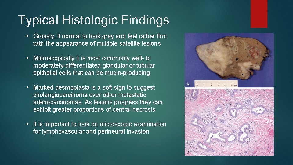 Typical Histologic Findings • Grossly, it normal to look grey and feel rather firm Typical Histologic Findings • Grossly, it normal to look grey and feel rather firm