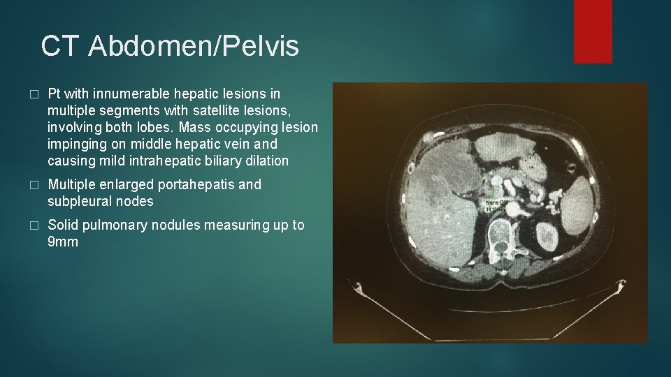 CT Abdomen/Pelvis � Pt with innumerable hepatic lesions in multiple segments with satellite lesions, CT Abdomen/Pelvis � Pt with innumerable hepatic lesions in multiple segments with satellite lesions,