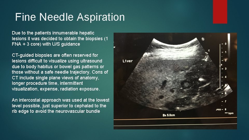 Fine Needle Aspiration Due to the patients innumerable hepatic lesions it was decided to Fine Needle Aspiration Due to the patients innumerable hepatic lesions it was decided to