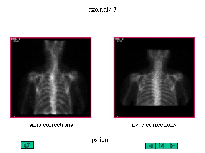 exemple 3 sans corrections avec corrections patient 