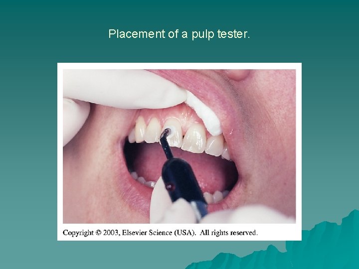 Placement of a pulp tester. Placement of a pulp tester.