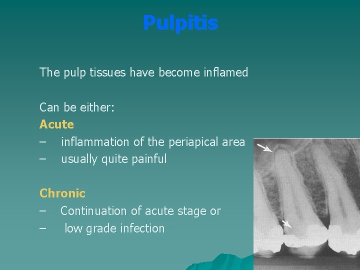 Pulpitis The pulp tissues have become inflamed Can be either: Acute – inflammation of Pulpitis The pulp tissues have become inflamed Can be either: Acute – inflammation of