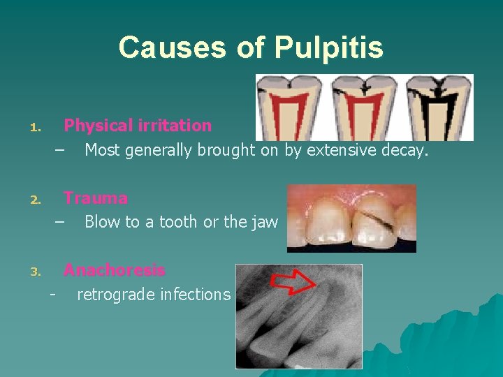 Causes of Pulpitis 1. Physical irritation – Most generally brought on by extensive decay. Causes of Pulpitis 1. Physical irritation – Most generally brought on by extensive decay.