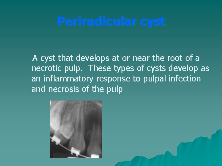 Periradicular cyst A cyst that develops at or near the root of a necrotic Periradicular cyst A cyst that develops at or near the root of a necrotic