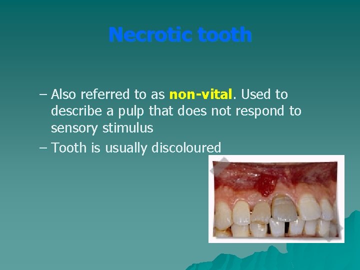 Necrotic tooth – Also referred to as non-vital. Used to describe a pulp that Necrotic tooth – Also referred to as non-vital. Used to describe a pulp that