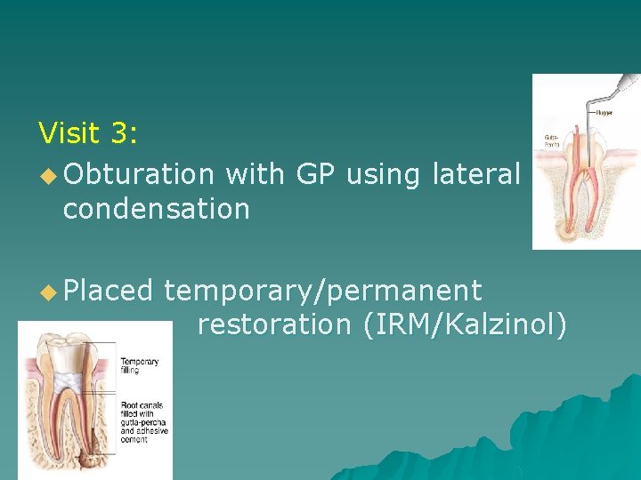 Visit 3: u Obturation with GP using lateral condensation u Placed temporary/permanent restoration (IRM/Kalzinol) Visit 3: u Obturation with GP using lateral condensation u Placed temporary/permanent restoration (IRM/Kalzinol)