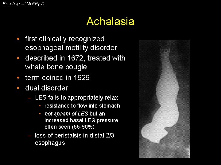 Esophageal Motility Dz Achalasia • first clinically recognized esophageal motility disorder • described in