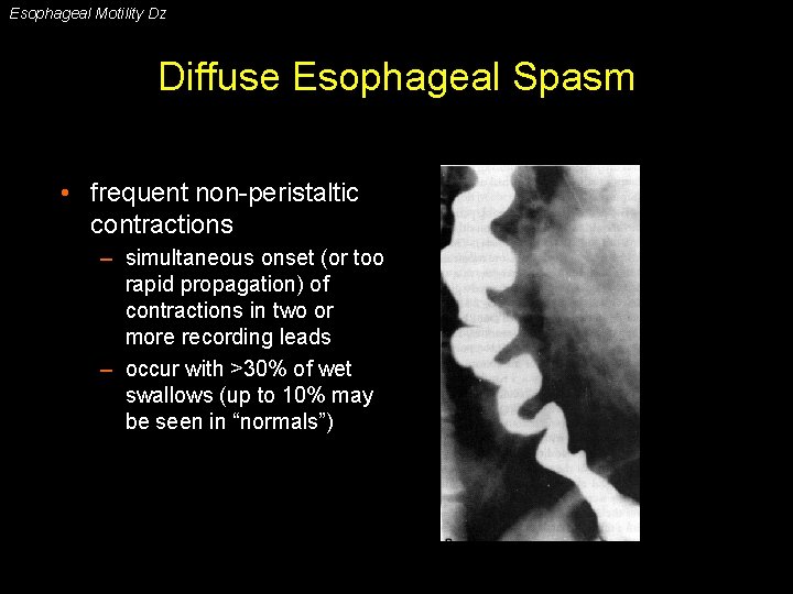 Esophageal Motility Dz Diffuse Esophageal Spasm • frequent non-peristaltic contractions – simultaneous onset (or