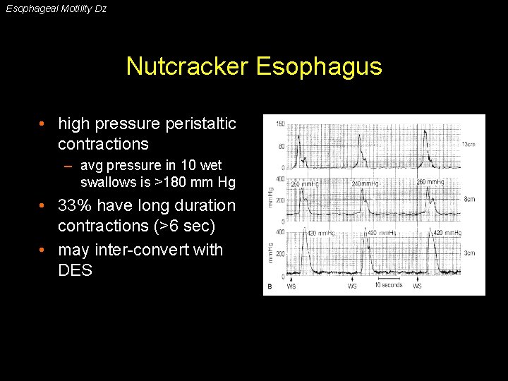 Esophageal Motility Dz Nutcracker Esophagus • high pressure peristaltic contractions – avg pressure in