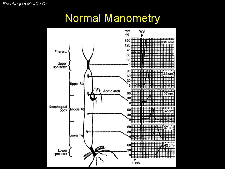 Esophageal Motility Dz Normal Manometry 