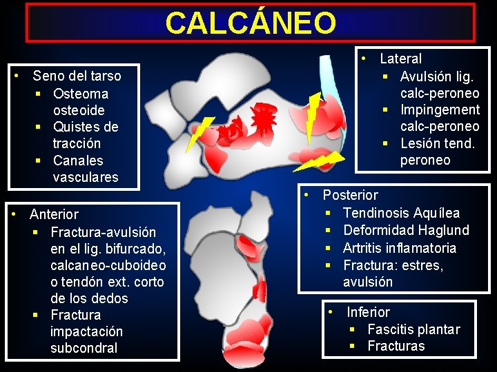 CALCÁNEO • Seno del tarso § Osteoma osteoide § Quistes de tracción § Canales