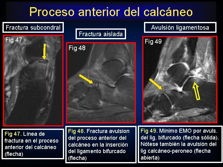 Proceso anterior del calcáneo Fractura subcondral Fig 47 Fractura aislada Fig 48 Fig 47.